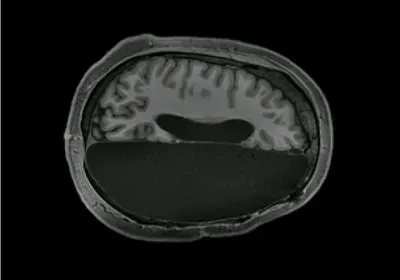 hemispherectomy epilepsy fmri brain neural connections hemispherectomy epilepsy fmri brain neural connections
